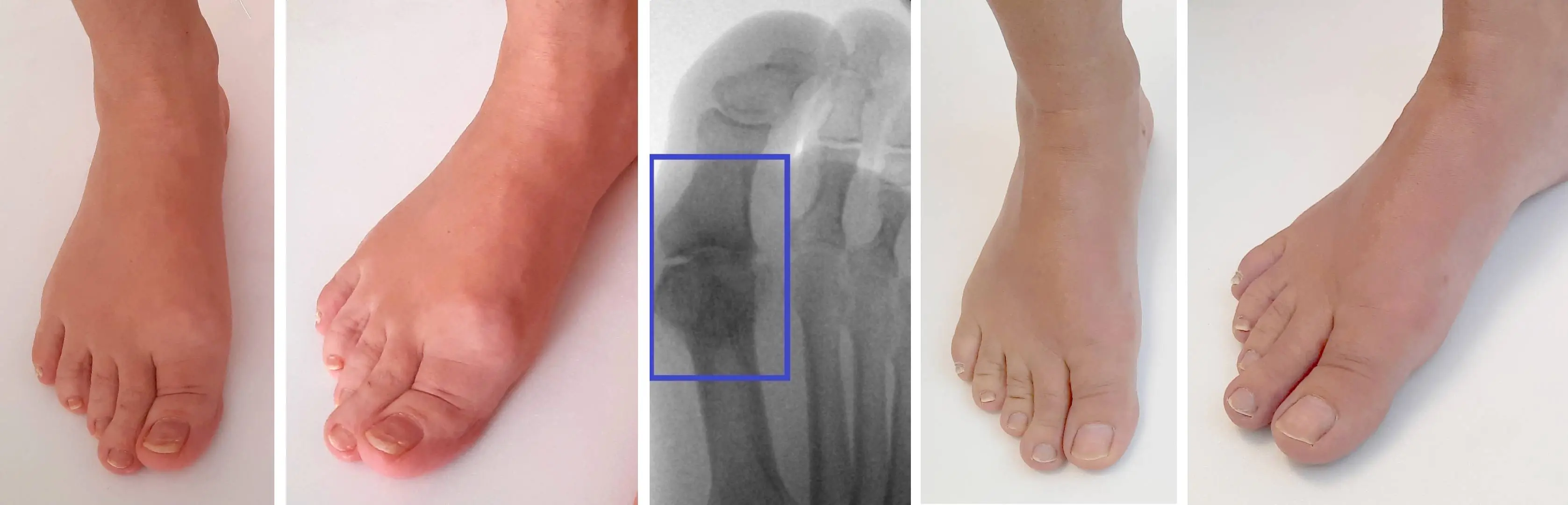 Osteoarthritis of the Toe