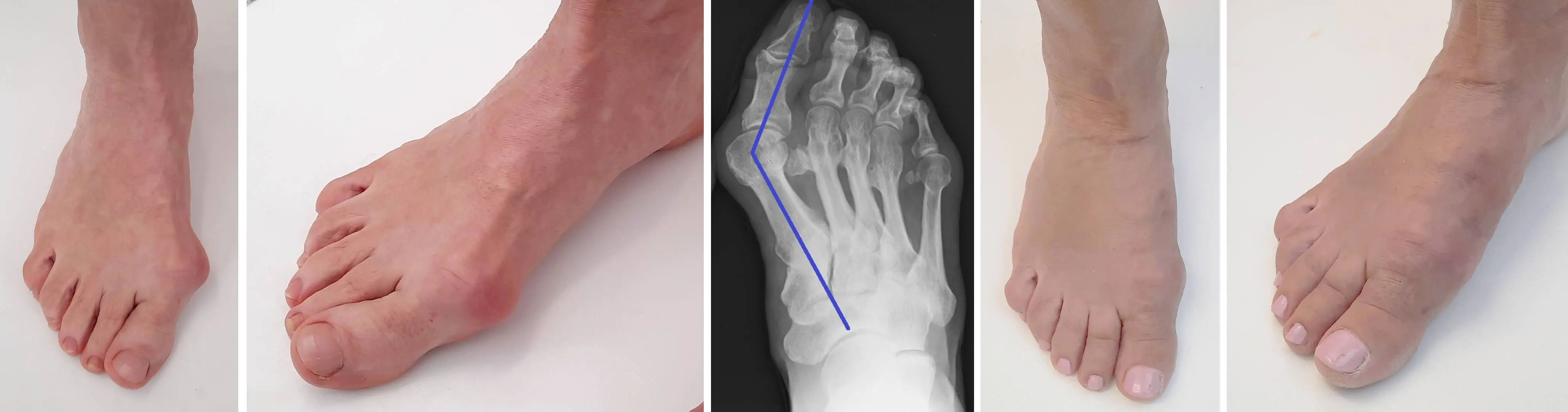 Buckled Toe (Bunion)