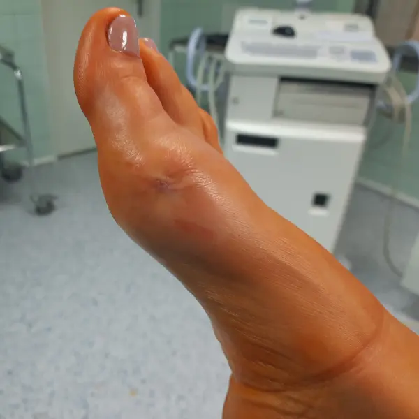 Minimally invasive treatment for thumb osteoarthritis - post-operative photo