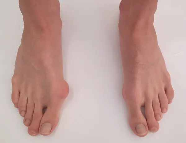 Bunion - Preoperative Photo