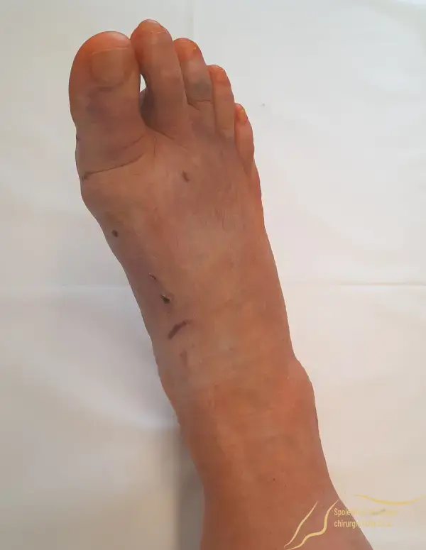 Postoperative swelling, hematomas