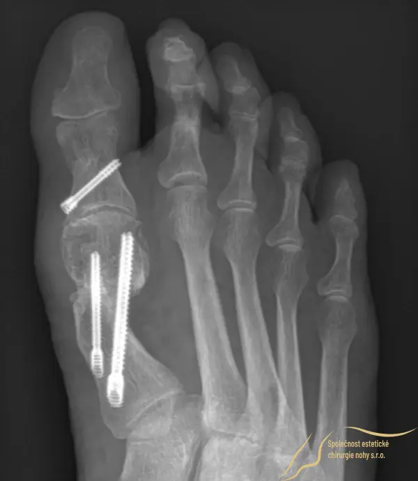 X-ray 4 months after surgery