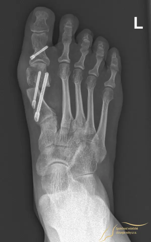 The thumb bones are secured in their new position with 3 screws