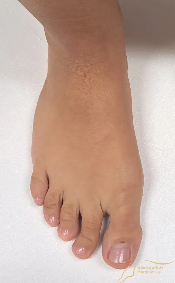 Preoperative photo of 2nd toe deformity