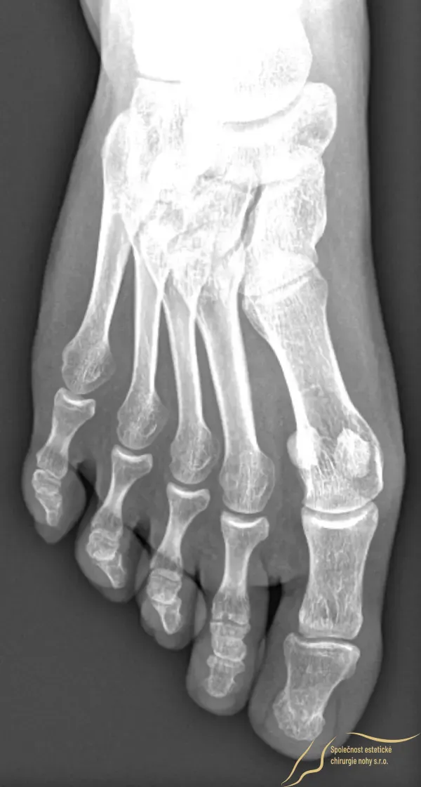 Postoperative X-ray 5 months after surgery